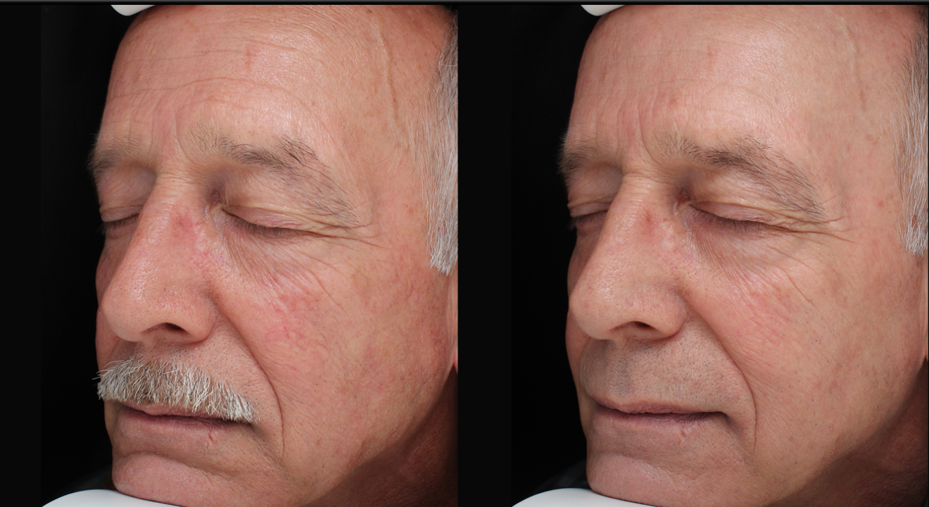 Clinic805-Before-After-IPL-1-1