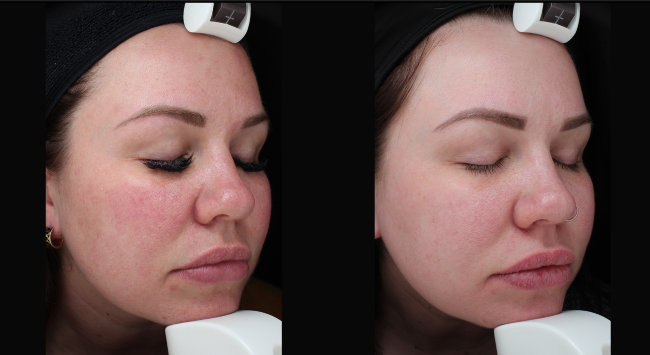 Clinic805-Before-After-IPL-2-2