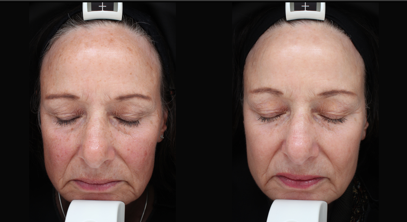 Clinic805-Before-After-IPL-3-1