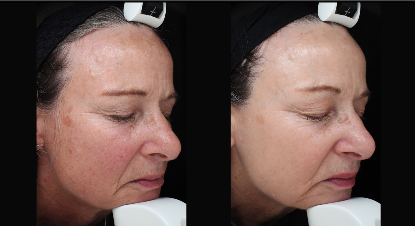 Clinic805-Before-After-IPL-3-2