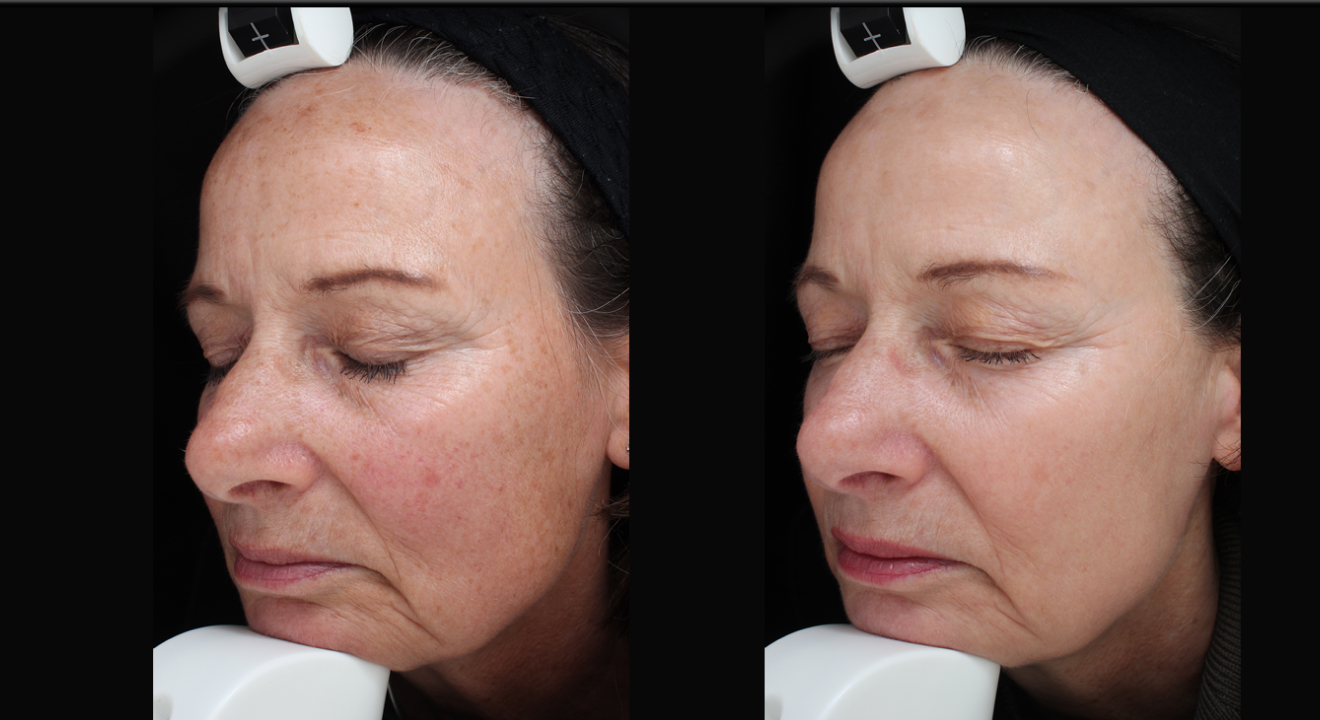 Clinic805-Before-After-IPL-3-3