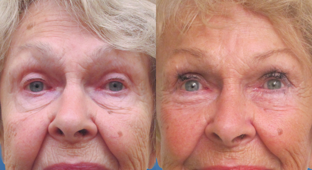 Clinic805-Victoria-Before-After-Blepharoplasty-5-1