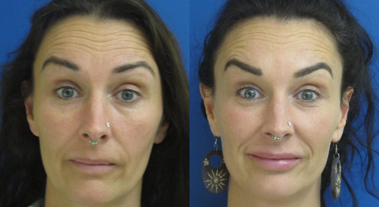 Clinic805-Victoria-Before-After-Botox-1-3