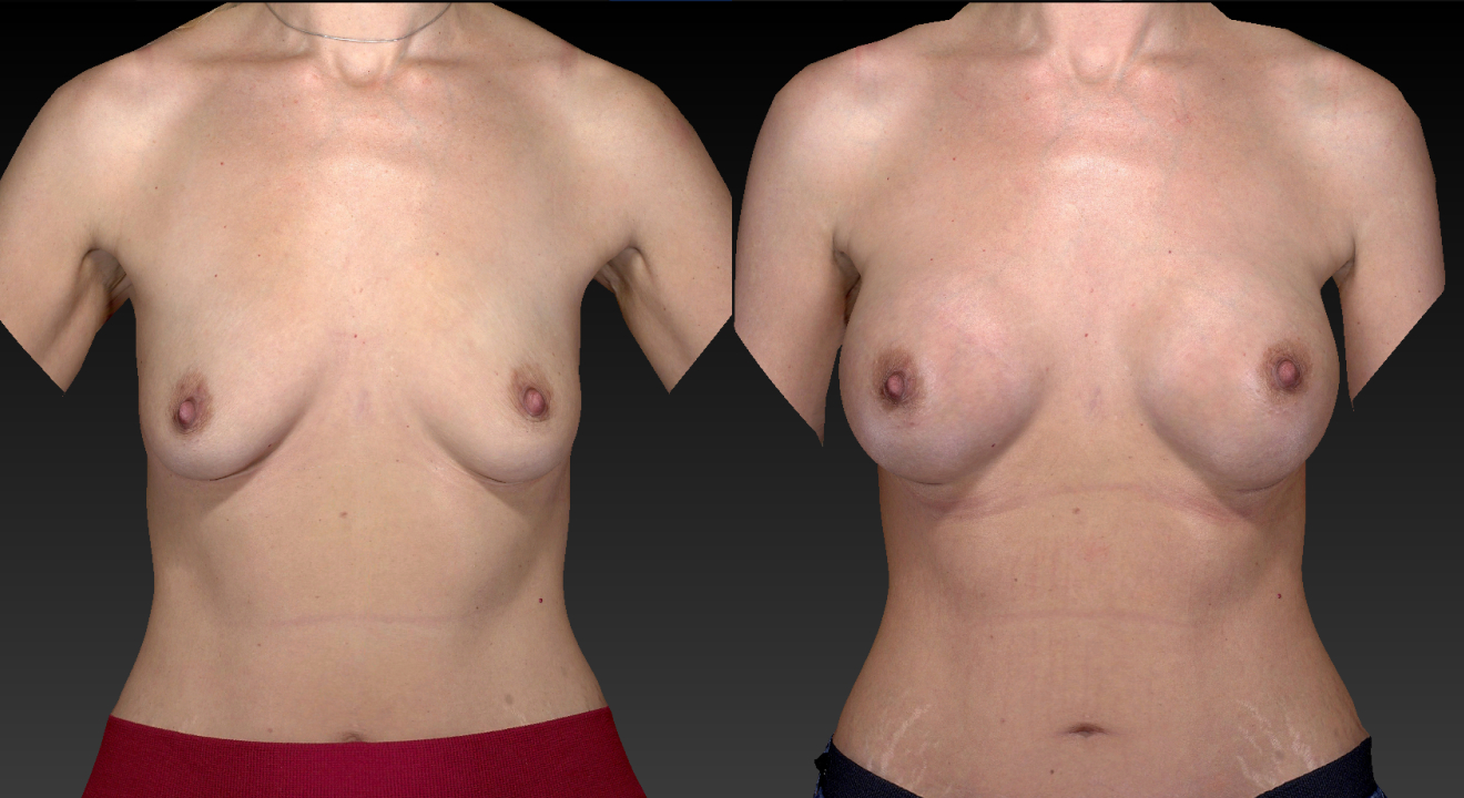 Clinic805-Victoria-Before-After-Breast-Augmentation-2-1