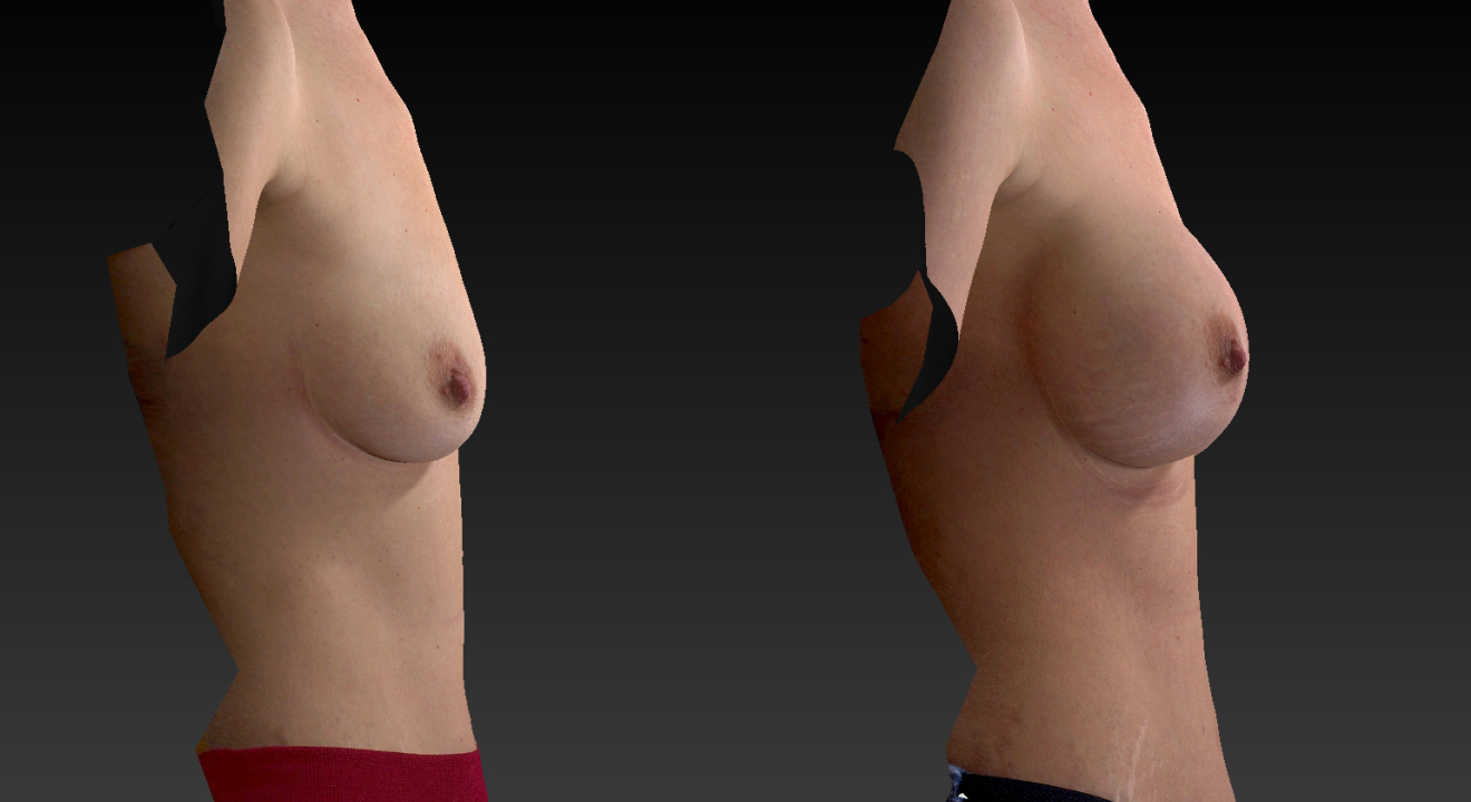 Clinic805-Victoria-Before-After-Breast-Augmentation-2-3