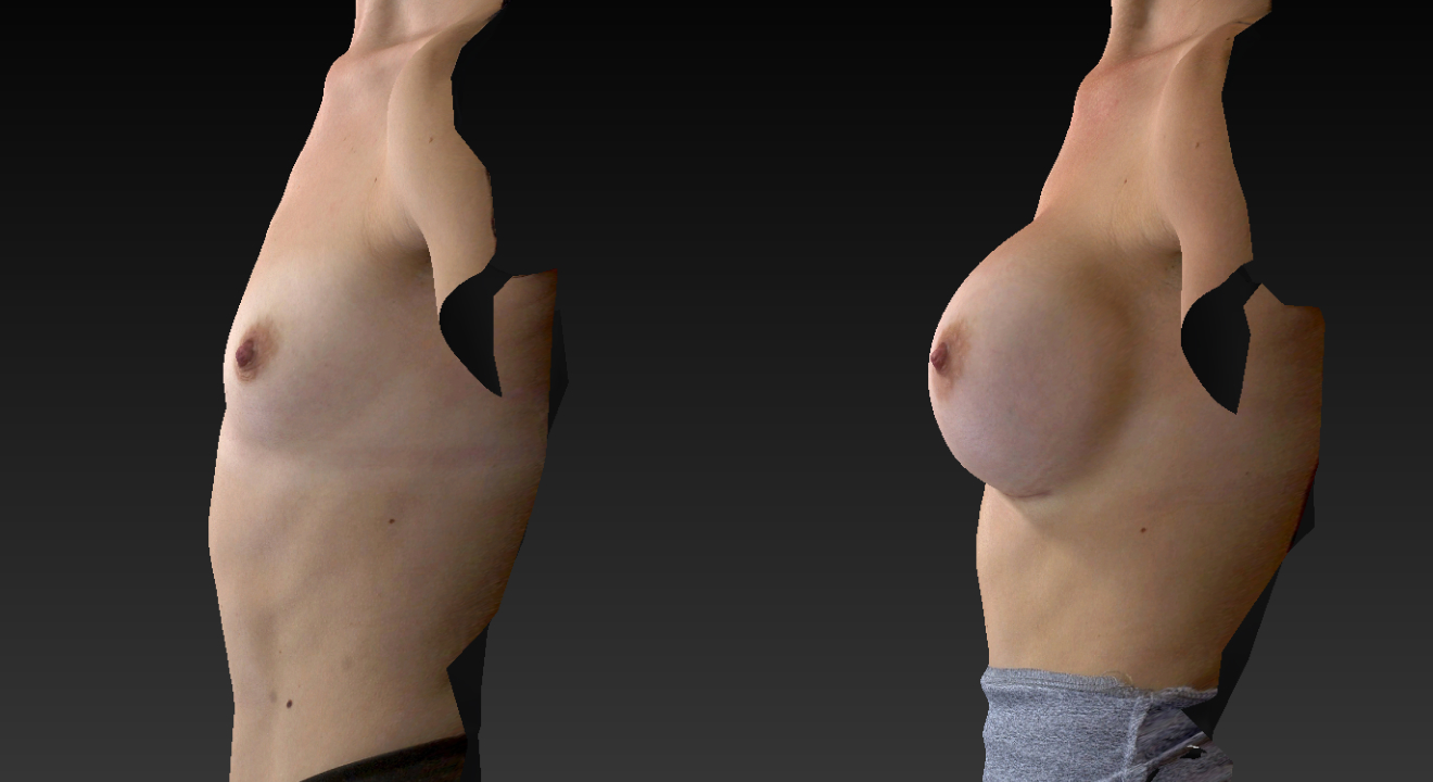 Clinic805-Victoria-Before-After-Breast-Augmentation-3-2
