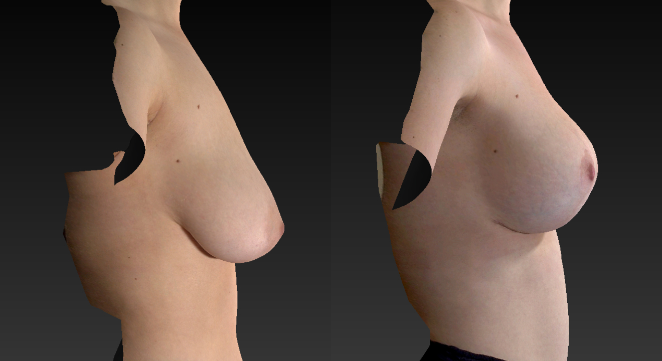 Clinic805-Victoria-Before-After-Breast-Augmentation-Lift-5-3