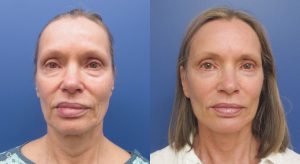 Clinic805-Victoria-Before-After-Face-Lift-1-1