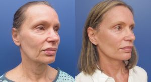 Clinic805-Victoria-Before-After-Face-Lift-1-2