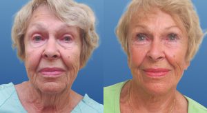 Clinic805-Victoria-Before-After-Face-Lift-4-1