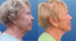 Clinic805-Victoria-Before-After-Face-Lift-4-2