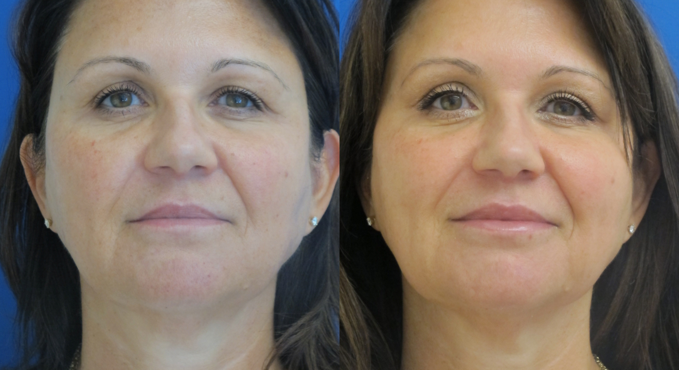 Clinic805-Victoria-Before-After-Filler-1-1
