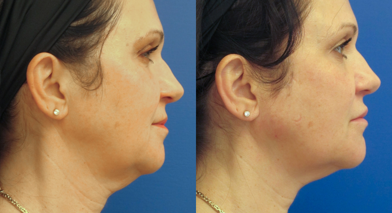 Clinic805-Victoria-Before-After-Filler-1-2