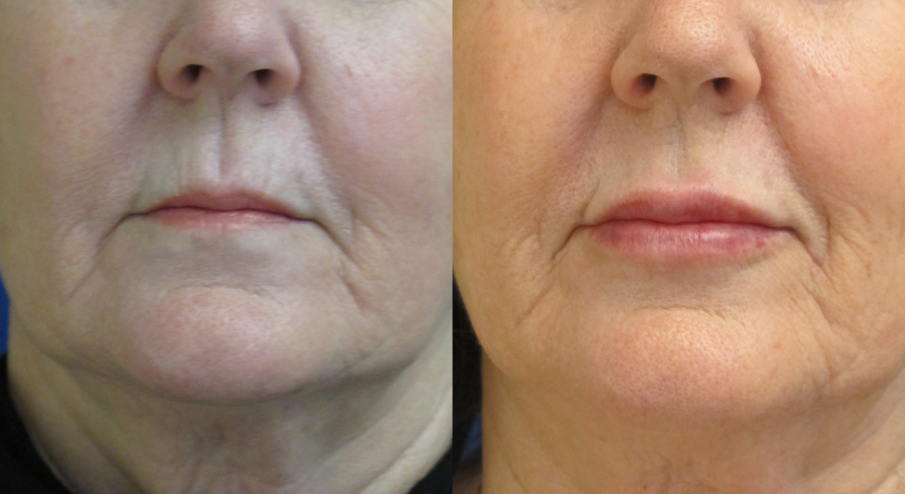 Clinic805-Victoria-Before-After-Filler-2-1