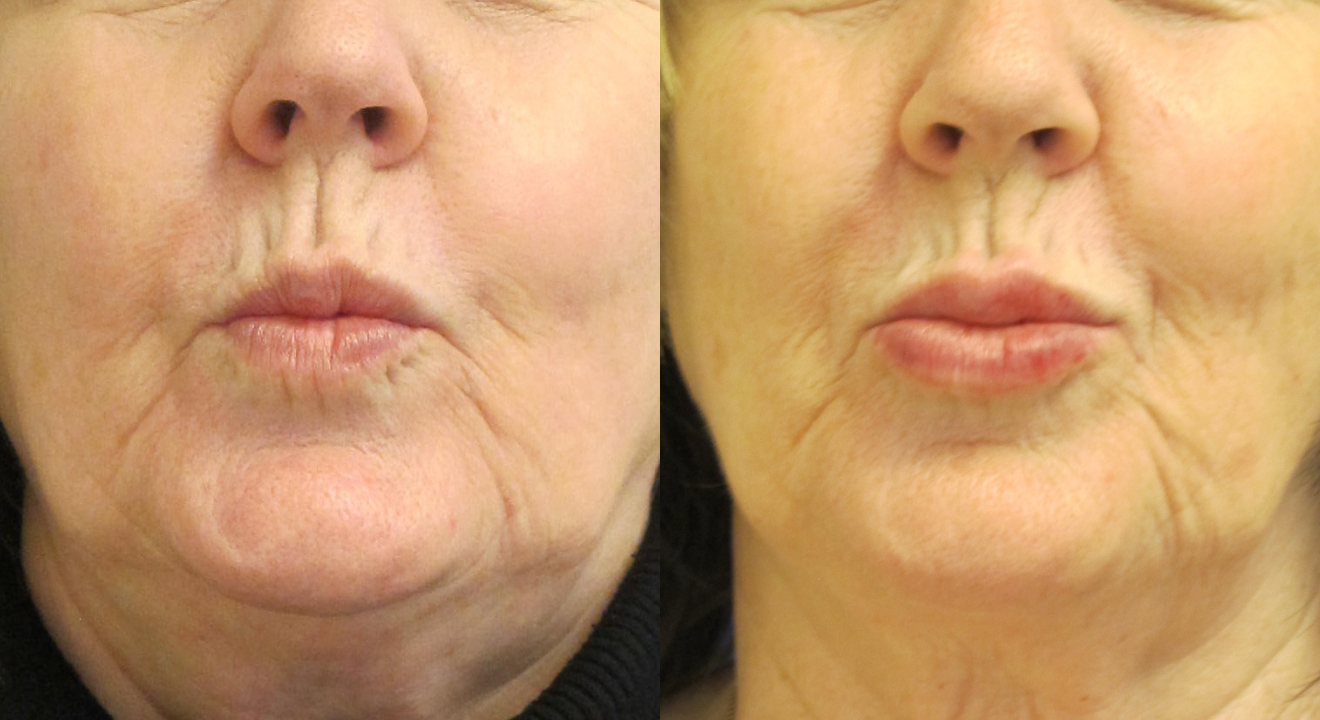 Clinic805-Victoria-Before-After-Filler-2-2-1