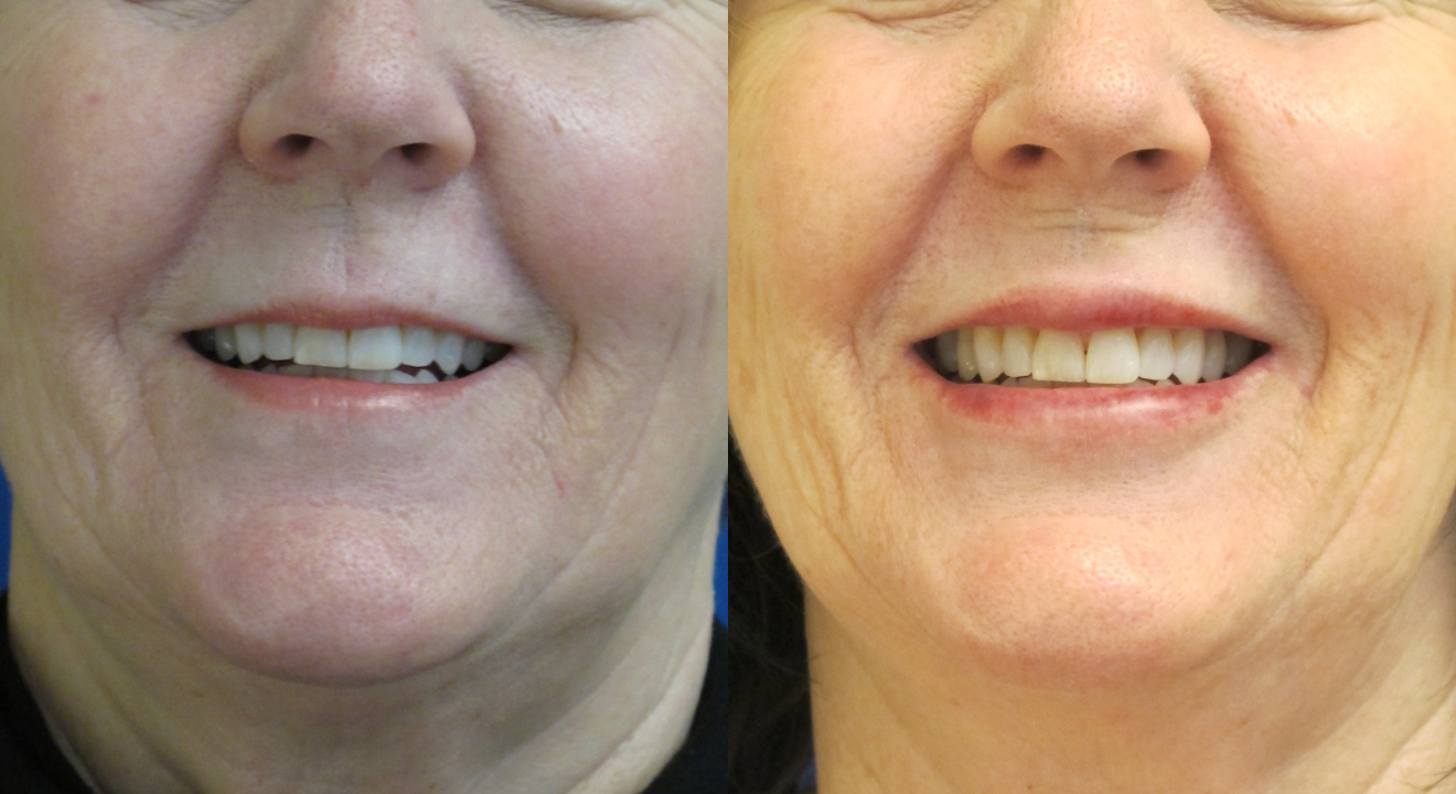 Clinic805-Victoria-Before-After-Filler-2-2