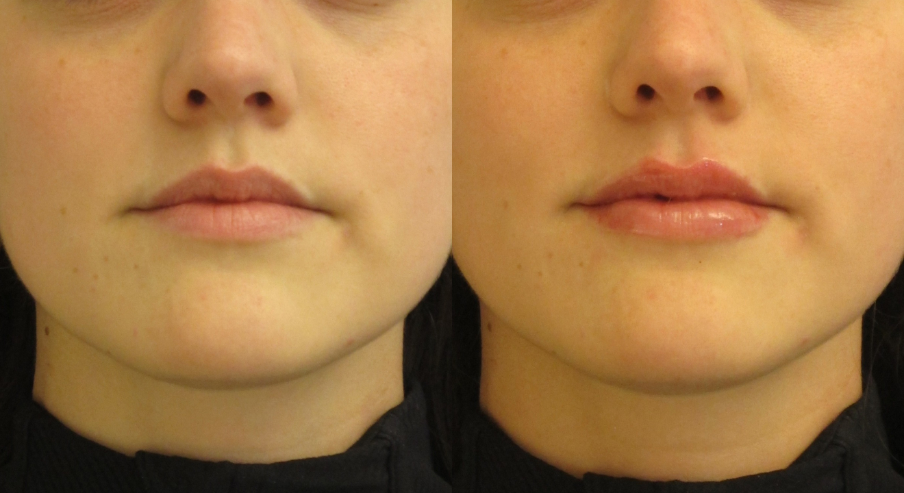 Clinic805-Victoria-Before-After-Filler-3-1