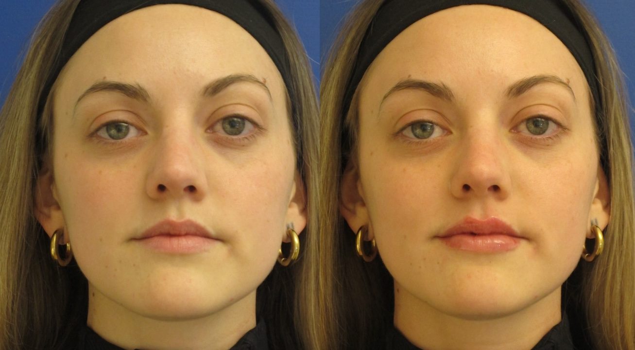 Clinic805-Victoria-Before-After-Filler-3-2