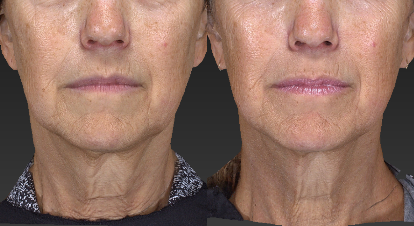 Clinic805-Victoria-Before-After-Morpheus8-Microneedling-1-1