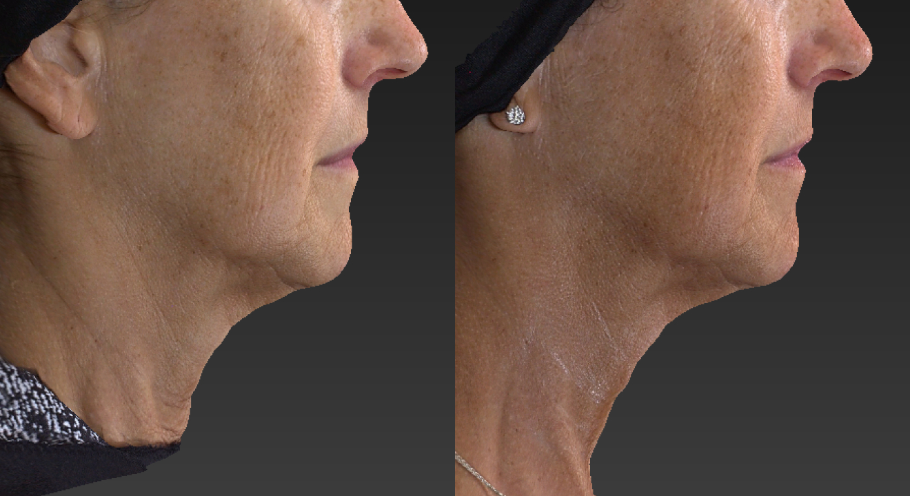 Clinic805-Victoria-Before-After-Morpheus8-Microneedling-1-2