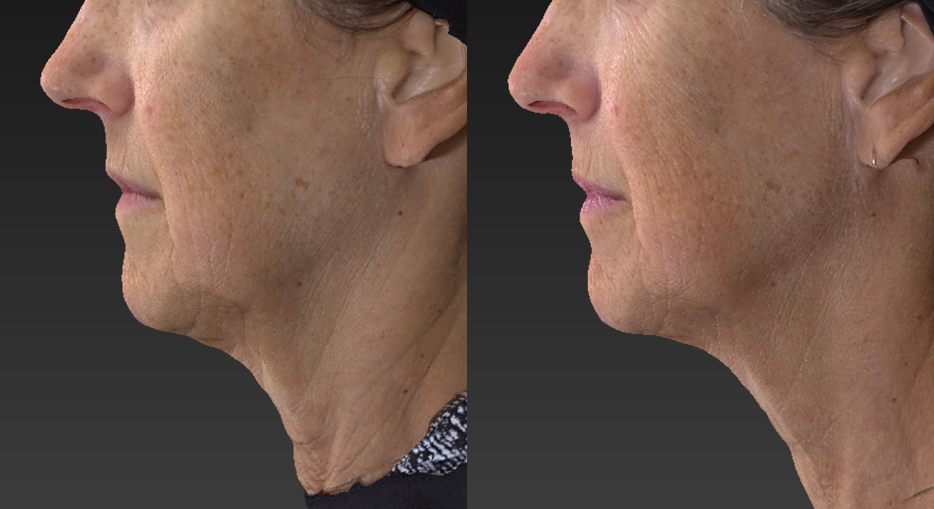 Clinic805-Victoria-Before-After-Morpheus8-Microneedling-1-3