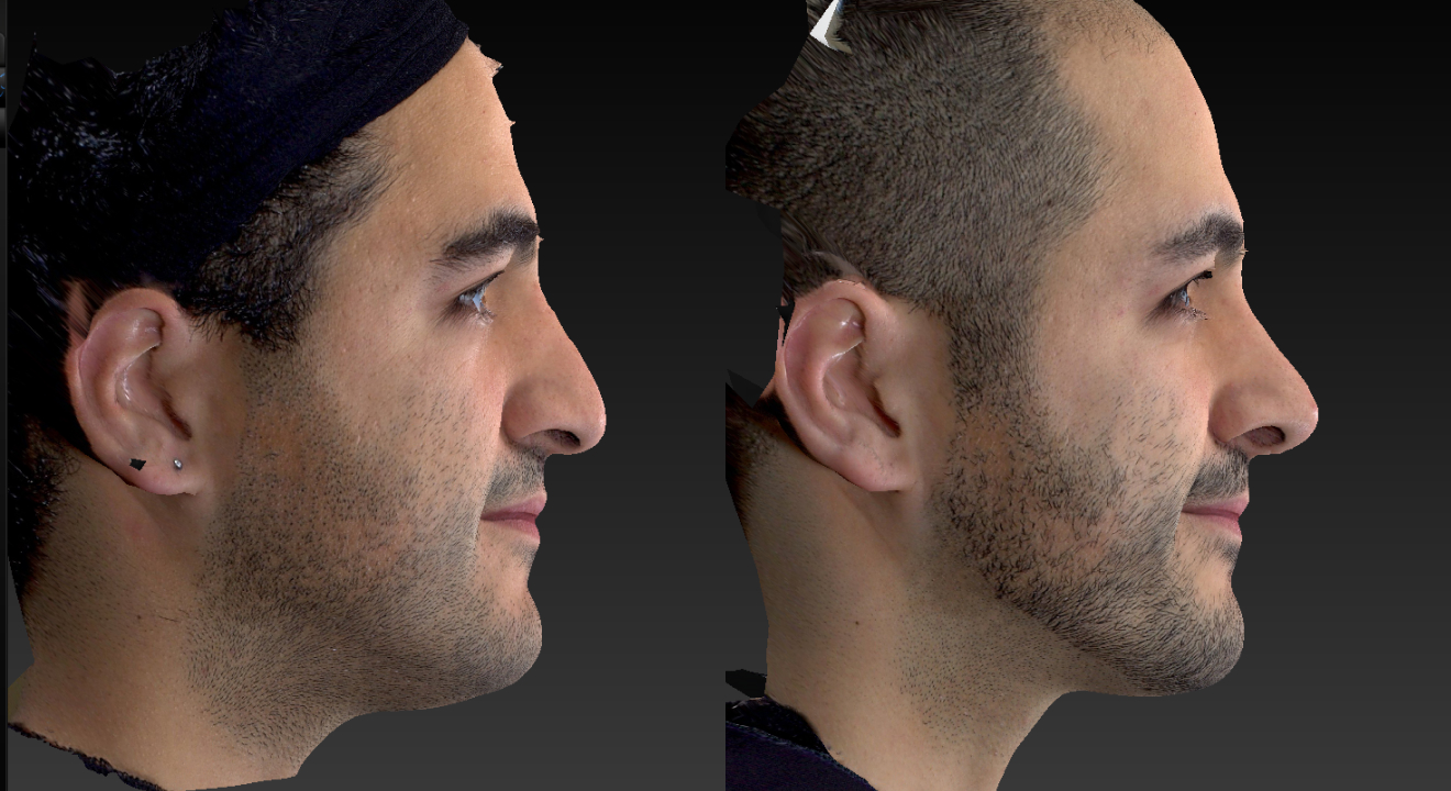 Clinic805-Victoria-Before-After-Rhinoplasty-1-1