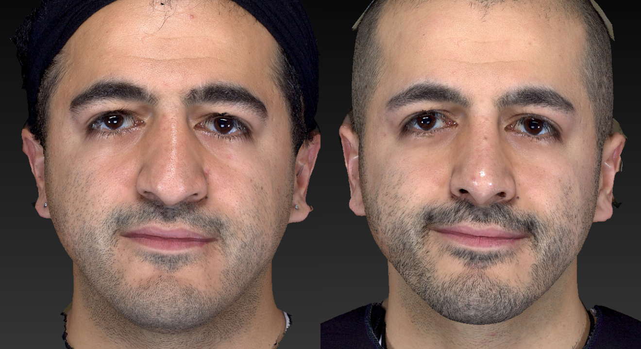 Clinic805-Victoria-Before-After-Rhinoplasty-1-2