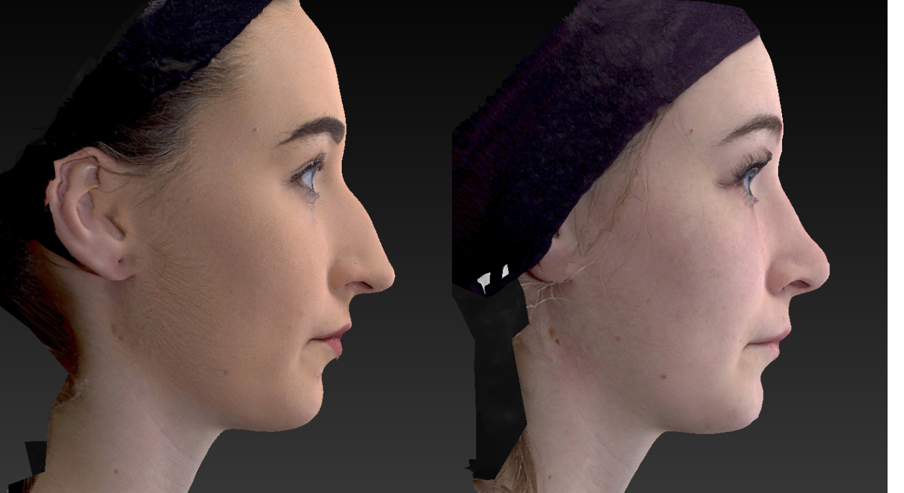 Clinic805-Victoria-Before-After-Rhinoplasty-2-1