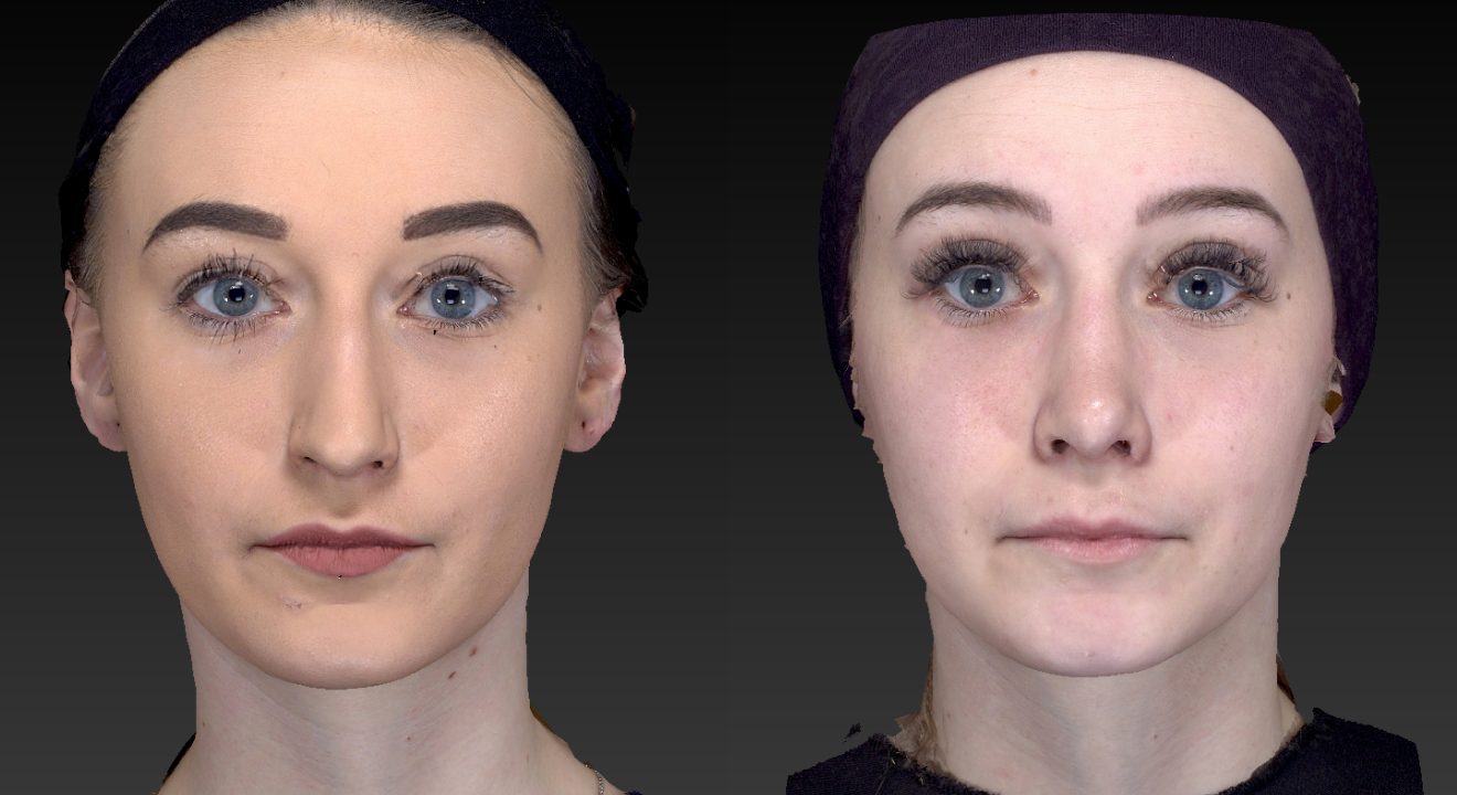 Clinic805-Victoria-Before-After-Rhinoplasty-2-2