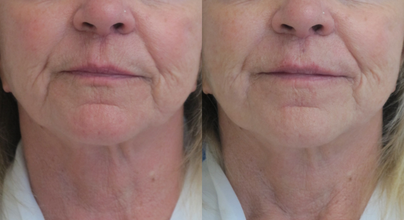 Clinic805-Victoria-Before-After-Volite-1-1