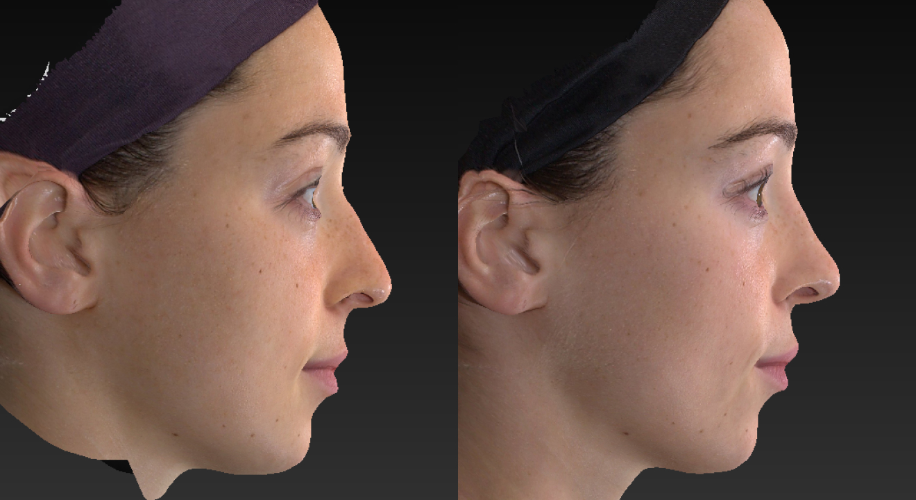 592007670-clinic805-victoria-before-after-rhinoplasty-4-1
