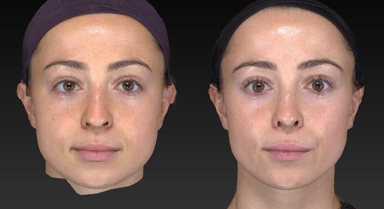 592007679-clinic805-victoria-before-after-rhinoplasty-4-2