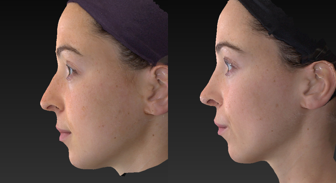 592007684-clinic805-victoria-before-after-rhinoplasty-4-3
